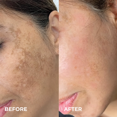 Kindral Tranexamic Brightening Cream
