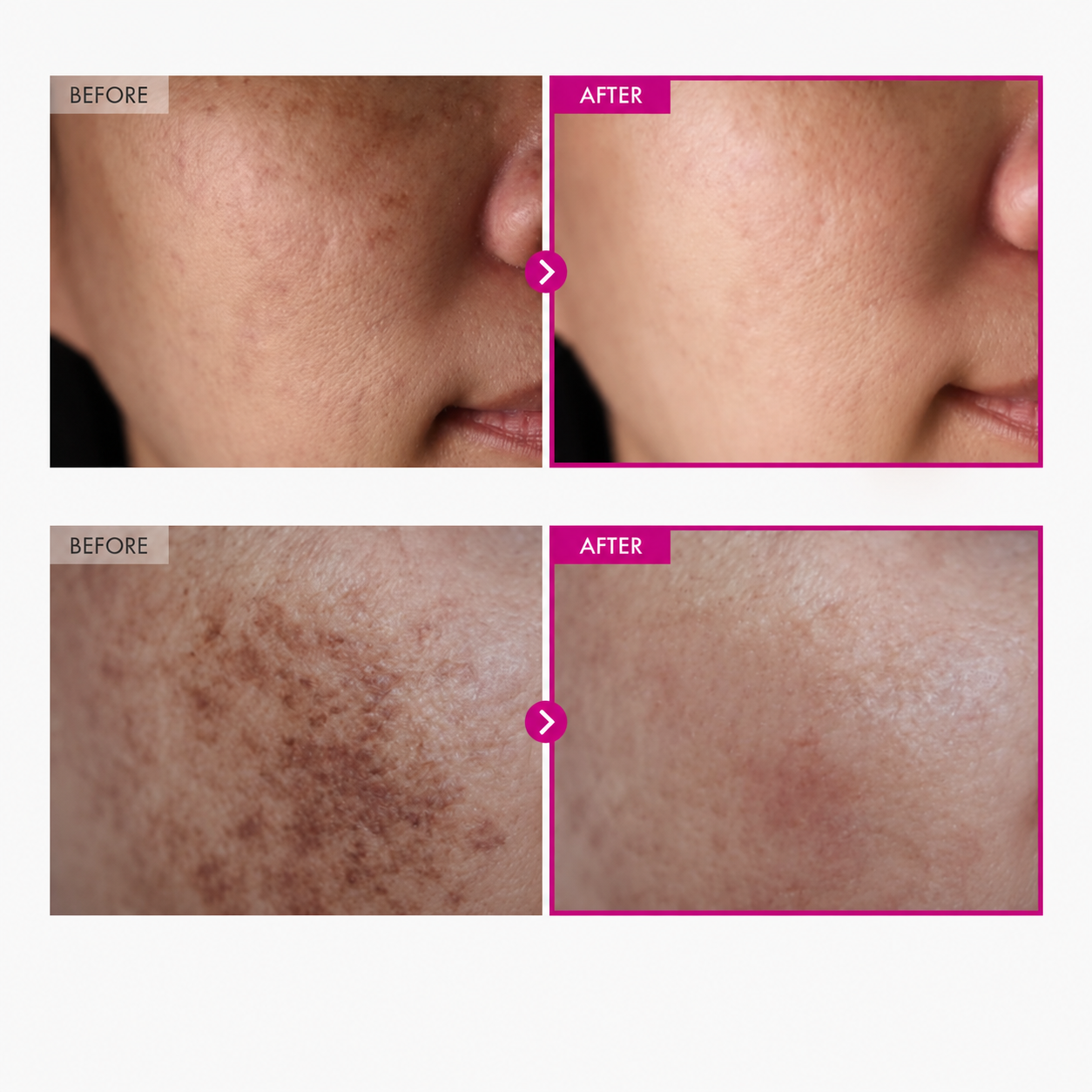 Clearer Skin Without the Clinic